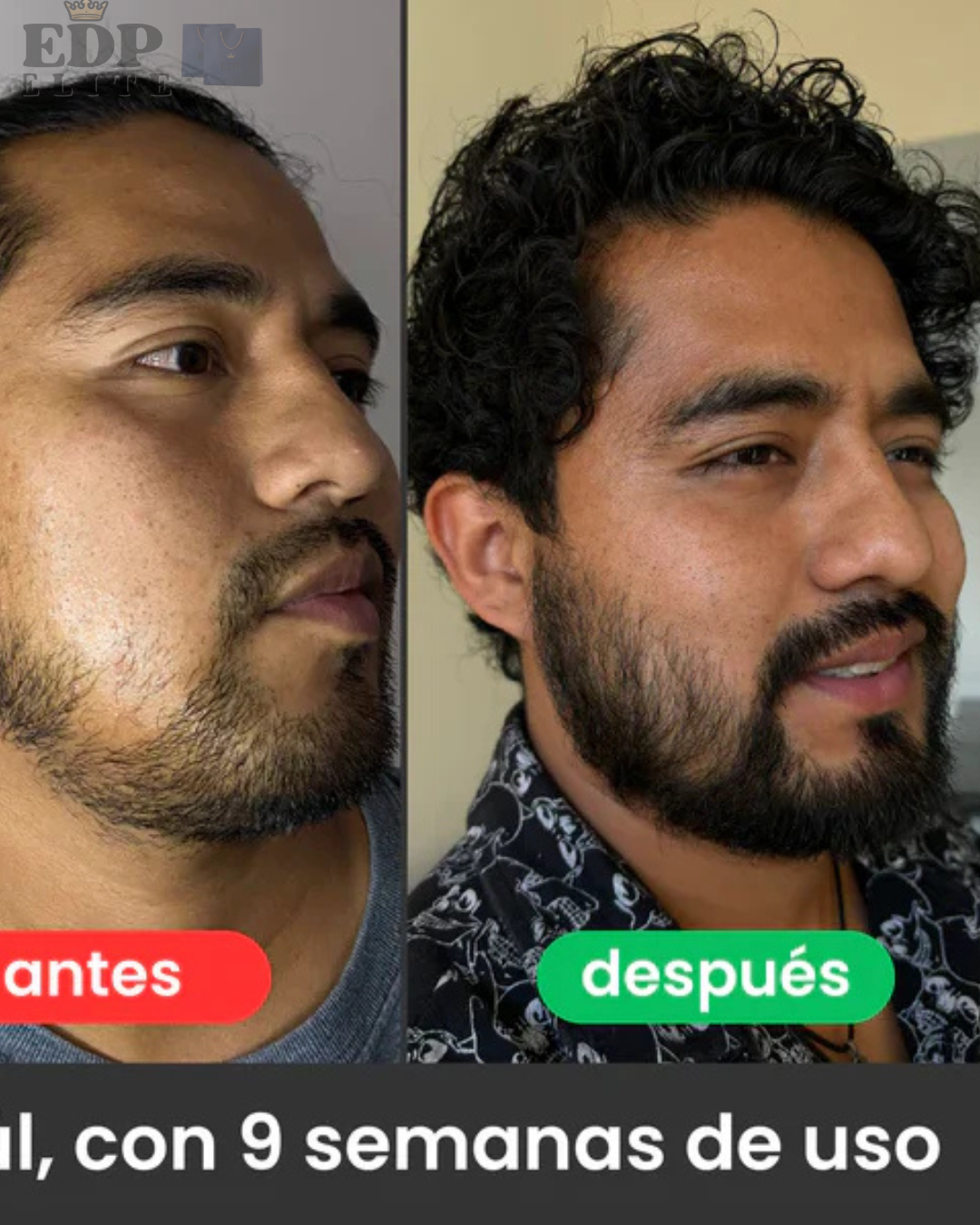 Minoxidil 20% Bálsamo Apolo Ultra-Estimulante de Barba (Cero Resequedad) – 100mL